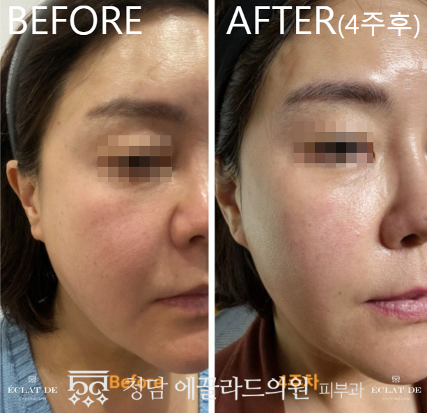 Oligio X 600 shots – Before & After from Eclat De