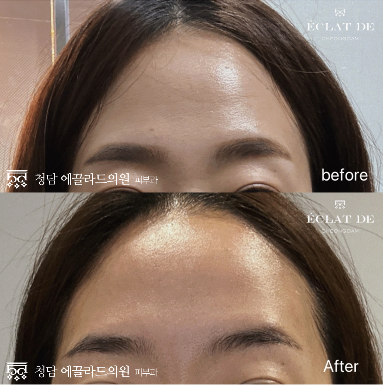 Emface – Before & After from Eclat De