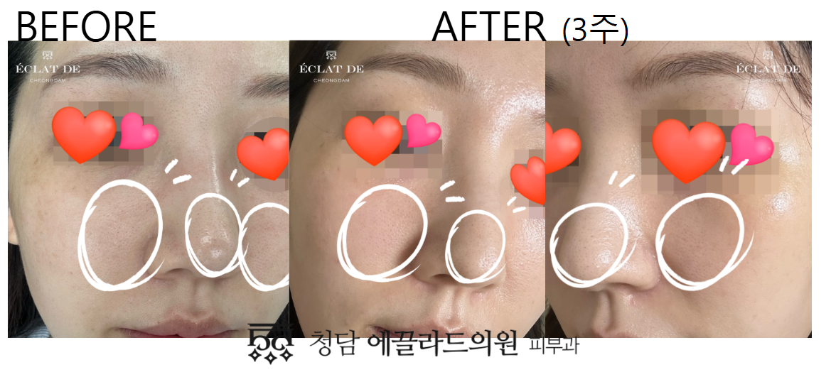 Ellisys Sense – Before & After from Eclat De