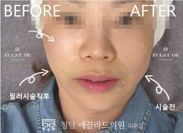 Full Face Filler – Before & After from Eclat De