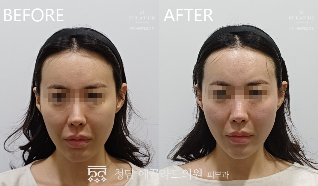 Emface – Before & After from Eclat De