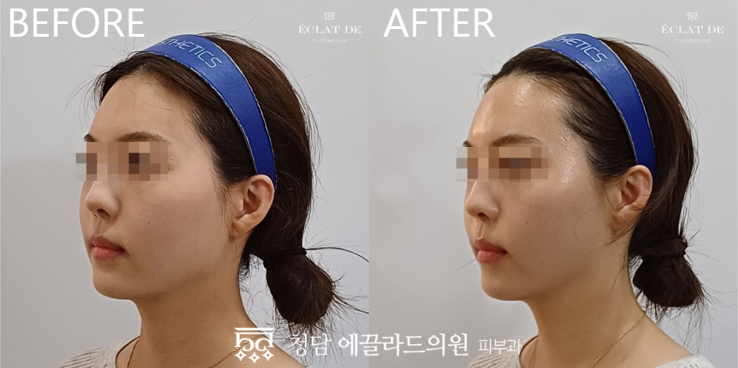 Titanium Lifting – Before & After from Eclat De
