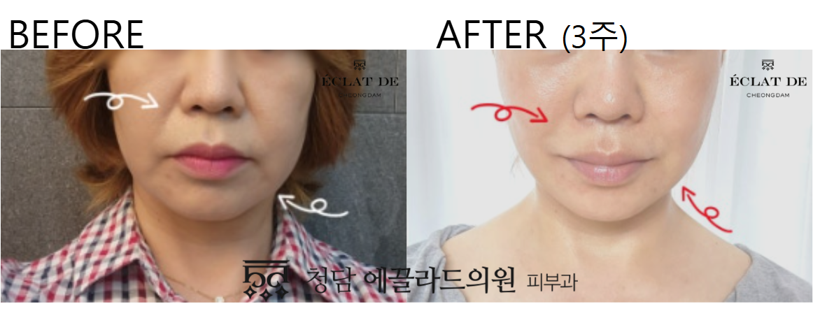 Radiesse – Before & After from Eclat De