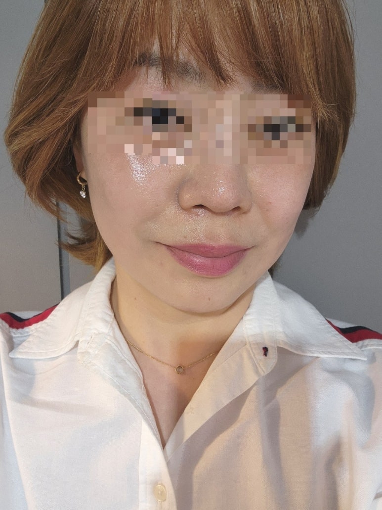 Ultherapy 300 Shots + ONDA Lifting Review